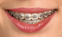 self ligating braces